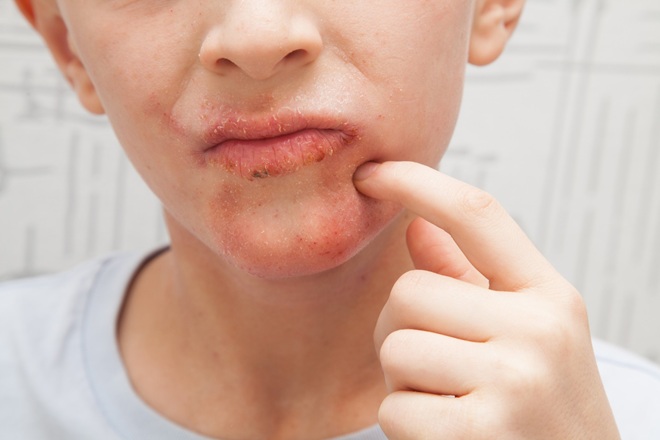 Herpes or Pimples: What Are You Dealing With?