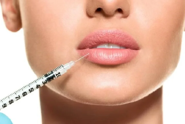The Secret to a Perfect Pout: Everything You Need to Know About Lips Fillers in Dubai